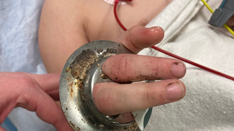 Rettung in Wiesbaden: Kinderfinger stecken in Abfluss-Sieb fest